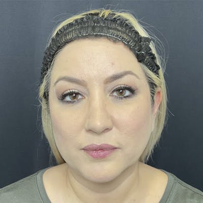 Chin Surgery Before & After Gallery - Patient 185745849 - Image 4