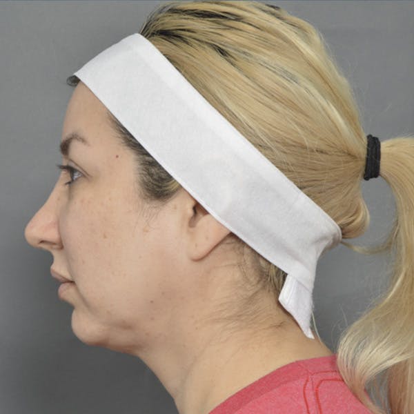 Chin Surgery Before & After Gallery - Patient 185745849 - Image 5