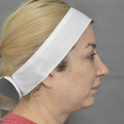 Chin Surgery Before & After Gallery - Patient 185745849 - Image 1