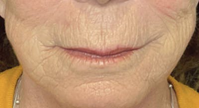 Lip Lift Before & After Gallery - Patient 185746861 - Image 1