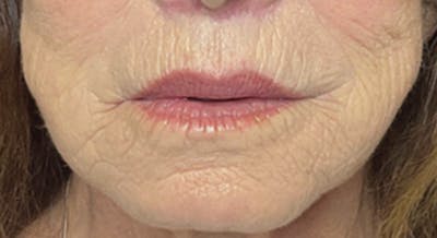 Lip Lift Before & After Gallery - Patient 185746861 - Image 2