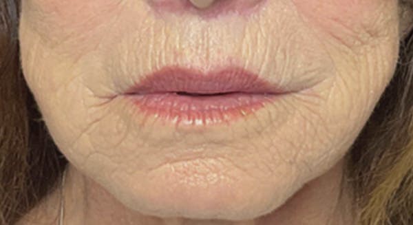 Lip Lift Before & After Gallery - Patient 185746861 - Image 2