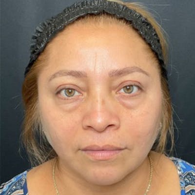 Eyelid Surgery Before & After Gallery - Patient 183513 - Image 1