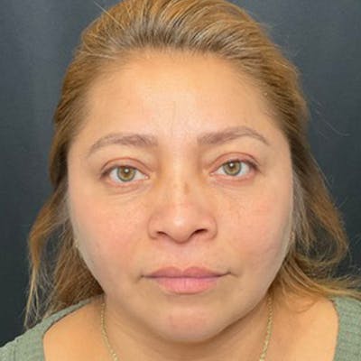 Eyelid Surgery Before & After Gallery - Patient 183513 - Image 2