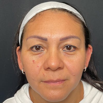 Eyelid Surgery Before & After Gallery - Patient 427948 - Image 1