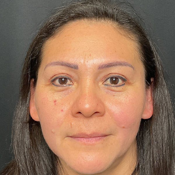 Eyelid Surgery Before & After Gallery - Patient 427948 - Image 2