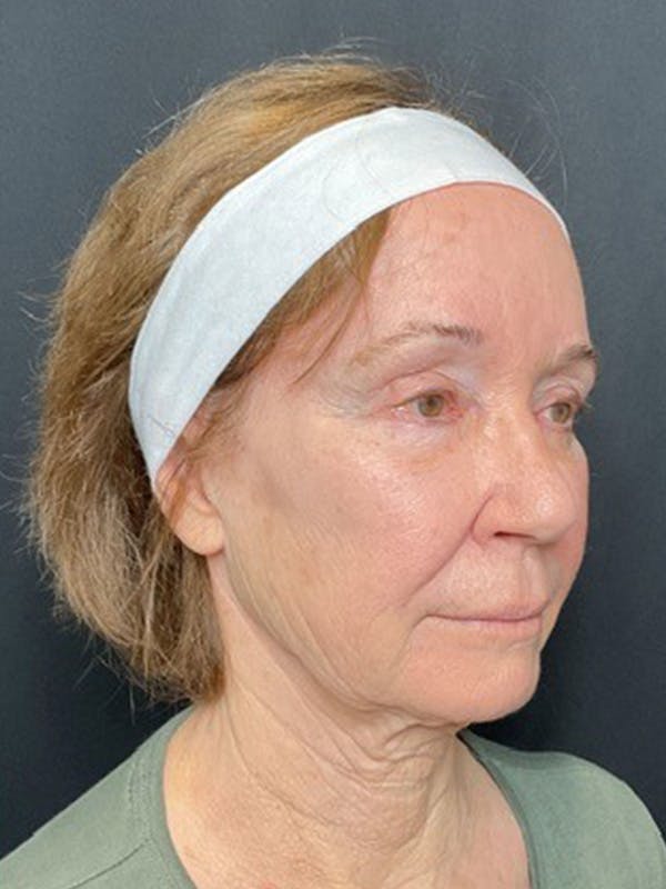 CO2 Laser Resurfacing Before & After Gallery - Patient 156609 - Image 1