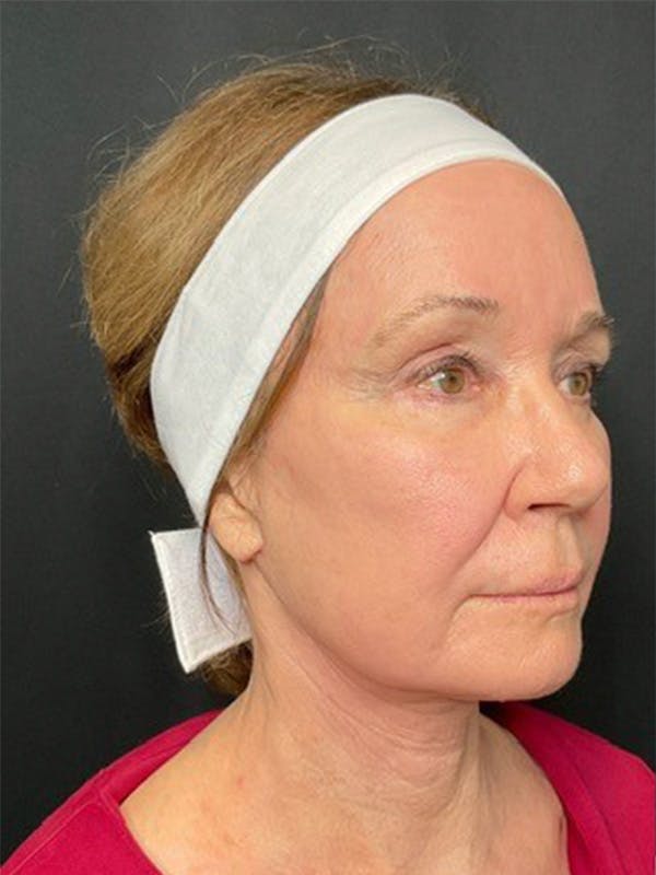 Neck Lift Before & After Gallery - Patient 335225 - Image 2