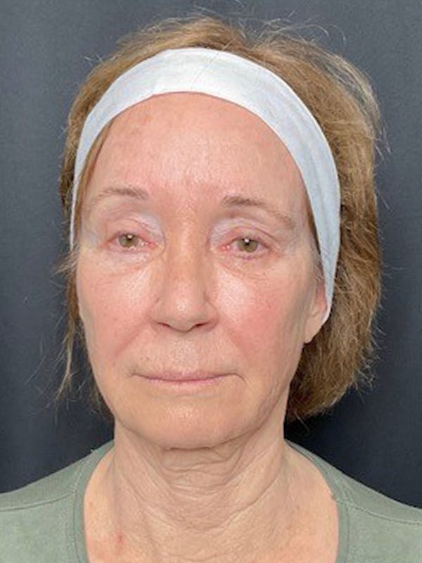 Neck Lift Before & After Gallery - Patient 335225 - Image 3