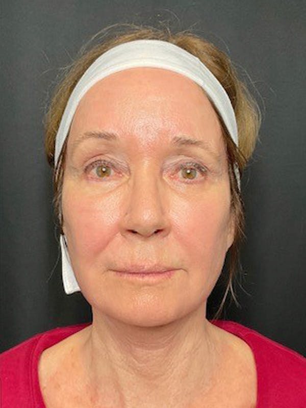 Neck Lift Before & After Gallery - Patient 335225 - Image 4