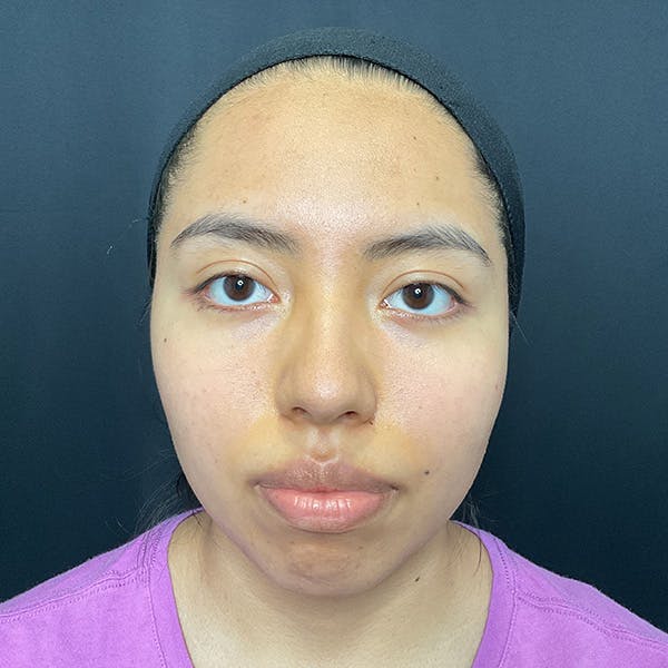 Buccal Fat Removal Before & After Gallery - Patient 137915 - Image 1