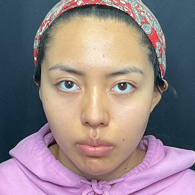 Buccal Fat Removal Before & After Gallery - Patient 137915 - Image 2