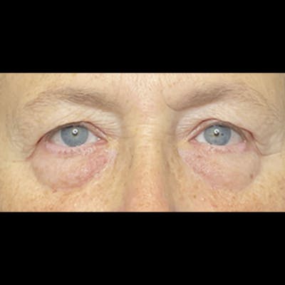 Eyelid Surgery Before & After Gallery - Patient 225994 - Image 1
