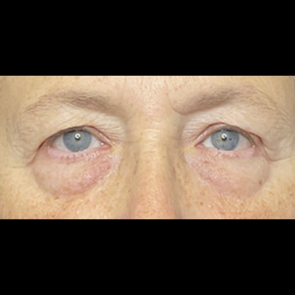 Eyelid Surgery Before & After Gallery - Patient 225994 - Image 1