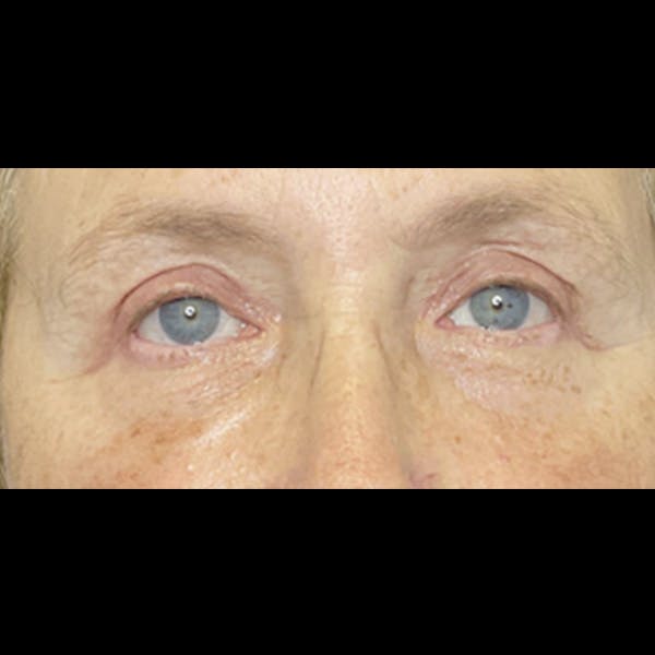 Eyelid Surgery Before & After Gallery - Patient 225994 - Image 2