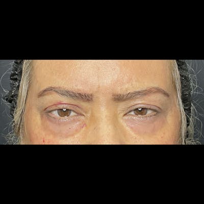 Eyelid Surgery Before & After Gallery - Patient 116507 - Image 1