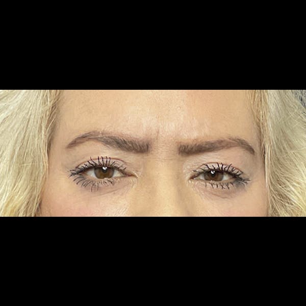 Eyelid Surgery Before & After Gallery - Patient 116507 - Image 2