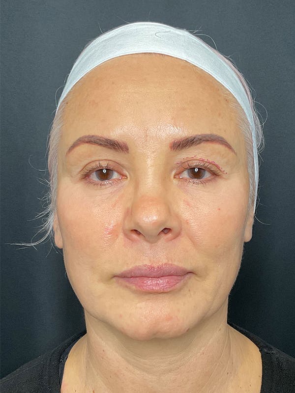 CO2 Laser Resurfacing Before & After Gallery - Patient 172344 - Image 1