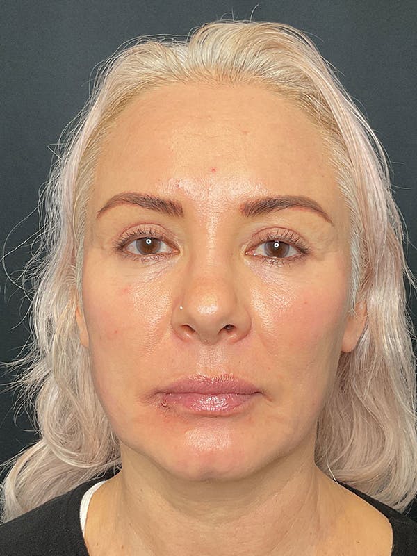 CO2 Laser Resurfacing Before & After Gallery - Patient 172344 - Image 2