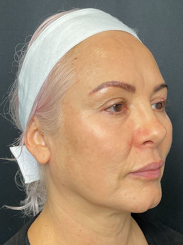 Eyelid Surgery Before & After Gallery - Patient 275359 - Image 3