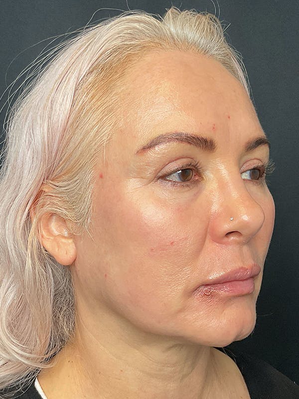 CO2 Laser Resurfacing Before & After Gallery - Patient 172344 - Image 4