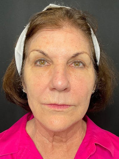 CO2 Laser Resurfacing Before & After Gallery - Patient 164662 - Image 1