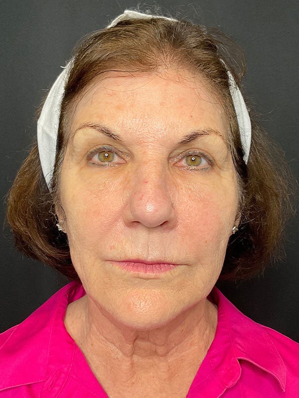 CO2 Laser Resurfacing Before & After Gallery - Patient 164662 - Image 1