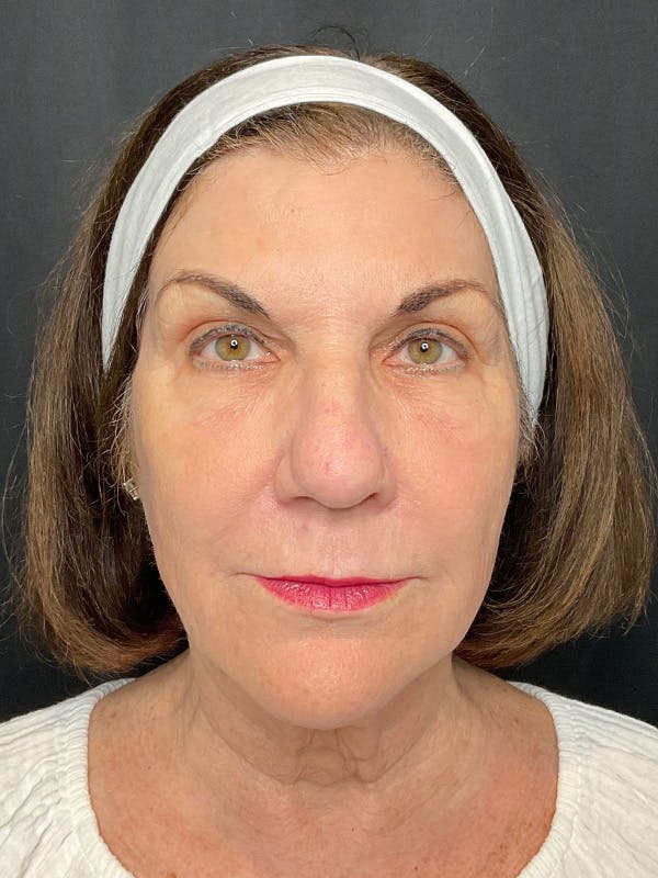 CO2 Laser Resurfacing Before & After Gallery - Patient 164662 - Image 2
