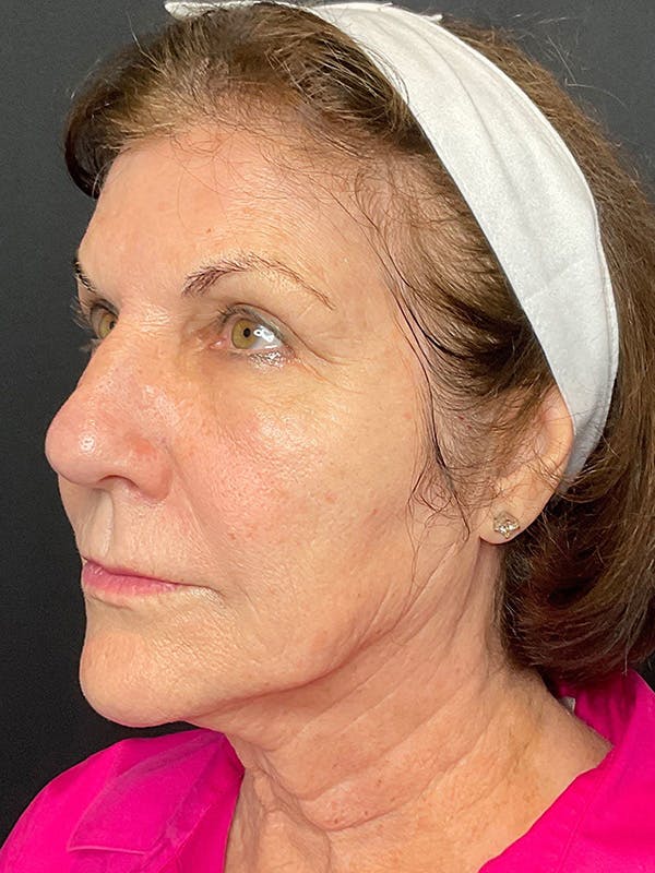CO2 Laser Resurfacing Before & After Gallery - Patient 164662 - Image 3