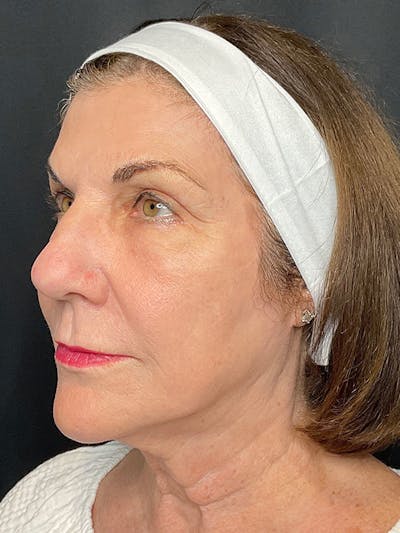 CO2 Laser Resurfacing Before & After Gallery - Patient 164662 - Image 4