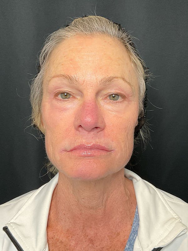 CO2 Laser Resurfacing Before & After Gallery - Patient 293529 - Image 1