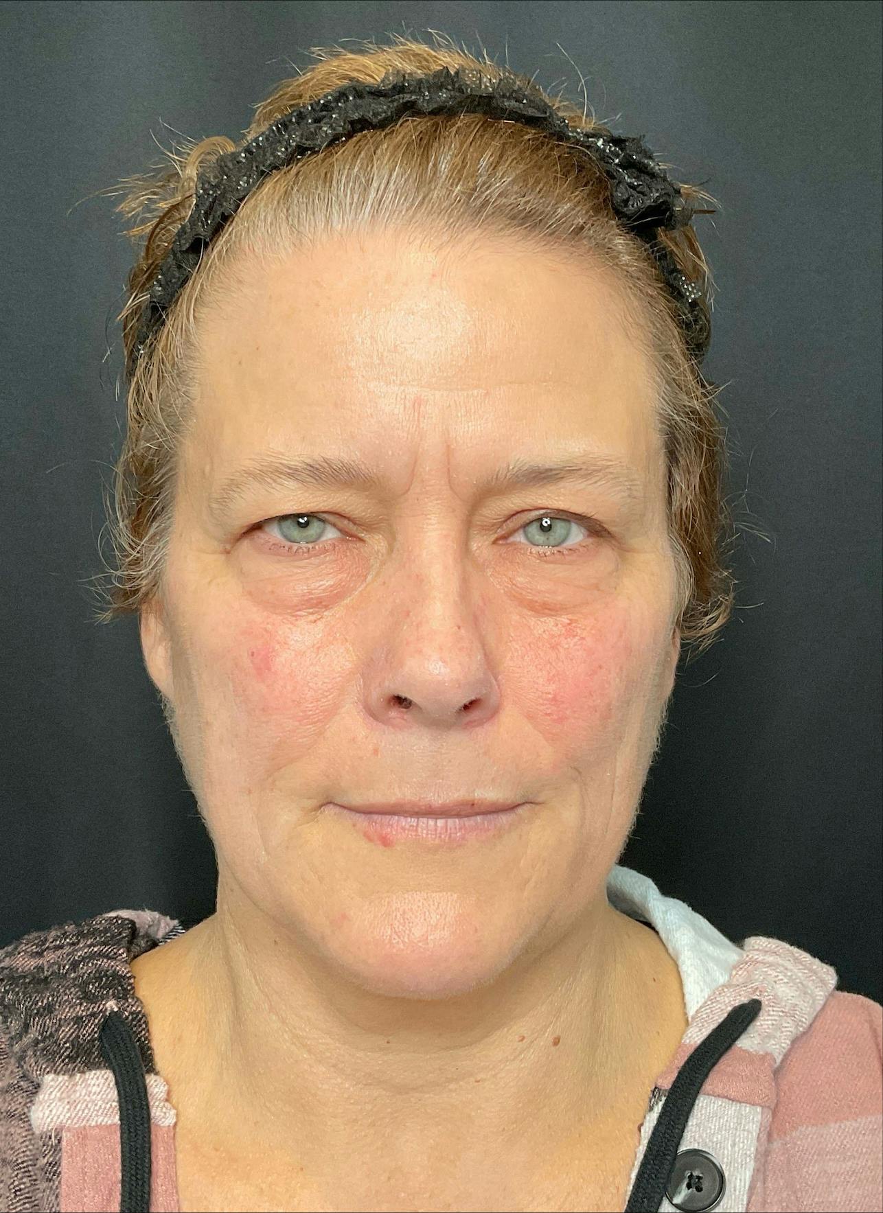 Eyelid Surgery Before & After Gallery - Patient 454295 - Image 2