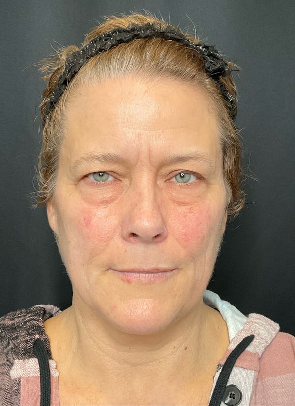 Eyelid Surgery Before & After Gallery - Patient 454295 - Image 2