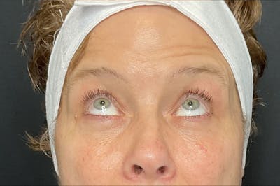 Eyelid Surgery Before & After Gallery - Patient 454295 - Image 4