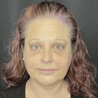 Eyelid Surgery Before & After Gallery - Patient 232499 - Image 2