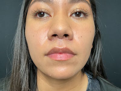 Lip Lift Before & After Gallery - Patient 379651 - Image 2