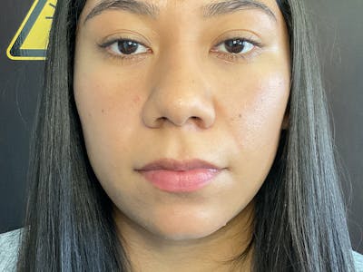 Lip Lift Before & After Gallery - Patient 379651 - Image 1