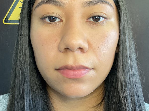 Lip Lift Before & After Gallery - Patient 379651 - Image 1