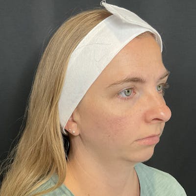Chin Surgery Before & After Gallery - Patient 945111 - Image 1