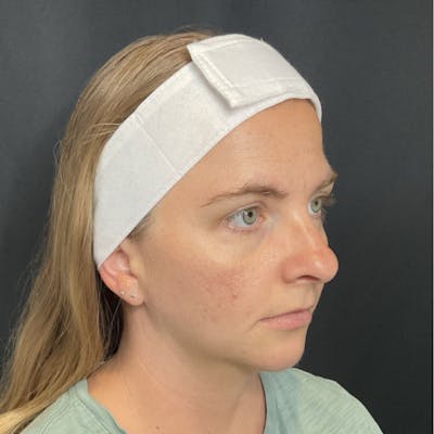 Chin Surgery Before & After Gallery - Patient 945111 - Image 2