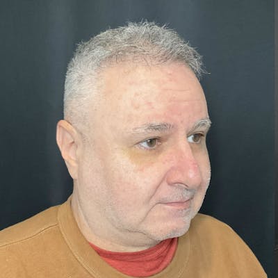 Chin Surgery Before & After Gallery - Patient 360761 - Image 1