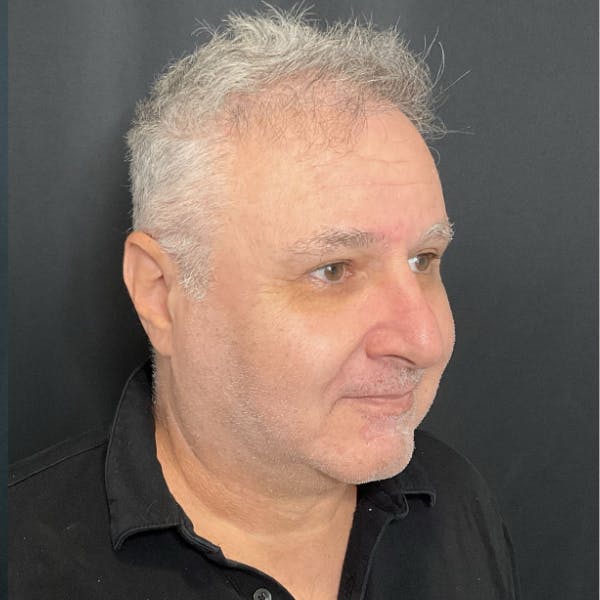 Chin Surgery Before & After Gallery - Patient 360761 - Image 2