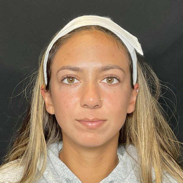 Chin Surgery Before & After Gallery - Patient 176740 - Image 3