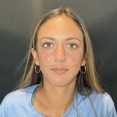 Chin Surgery Before & After Gallery - Patient 176740 - Image 4