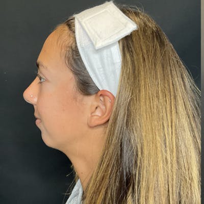Chin Surgery Before & After Gallery - Patient 176740 - Image 1