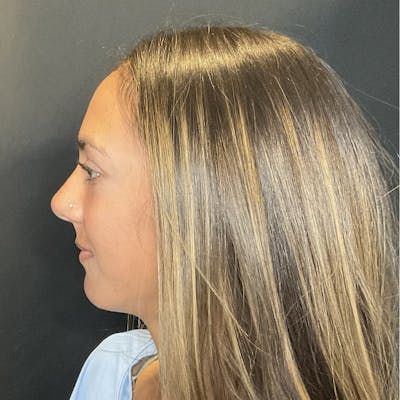 Chin Surgery Before & After Gallery - Patient 176740 - Image 2