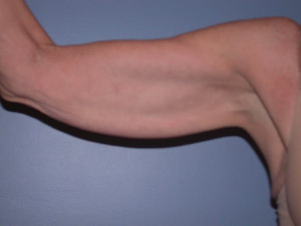 Arm Lift