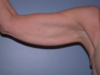 Arm Lift Before & After Gallery - Patient 4752090 - Image 1