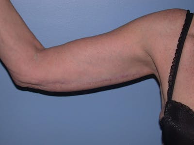 Arm Lift Gallery Before & After Gallery - Patient 4752090 - Image 2