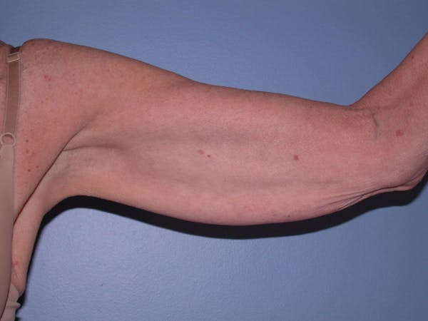 Arm Lift Gallery Before & After Gallery - Patient 4752090 - Image 3